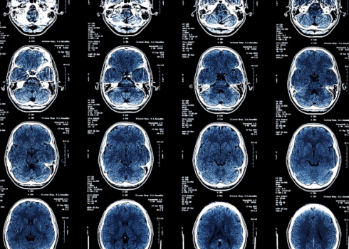 MRI images showing white matter tracts in the brain.