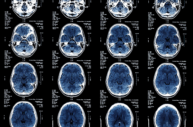 MRI images showing white matter tracts in the brain.